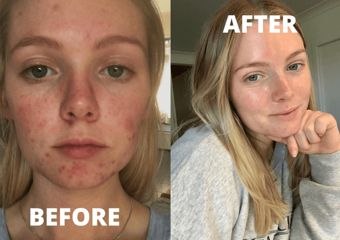 How Georgie Harris Transformed Her Breakout-Prone Skin
