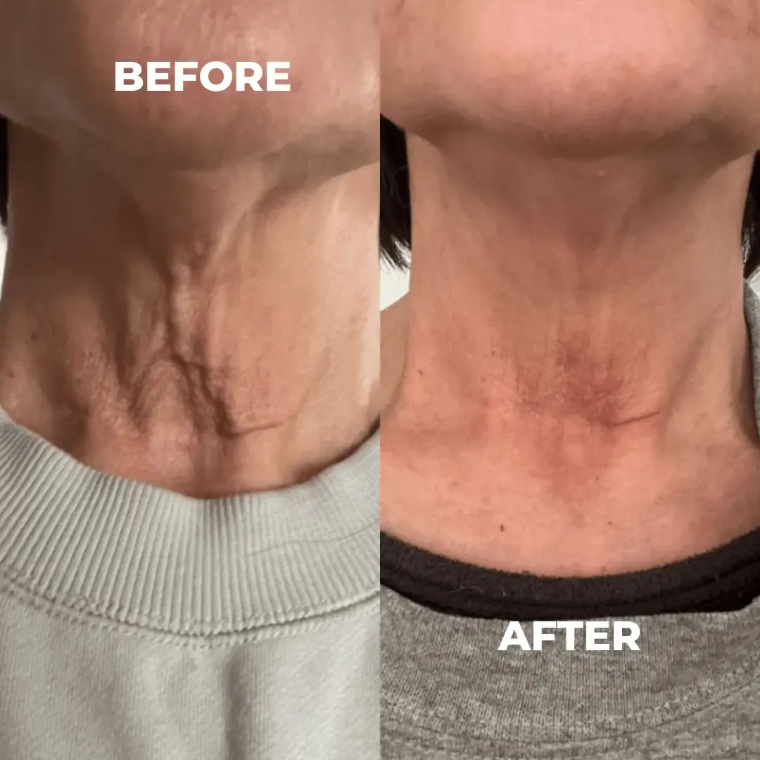 Before and after comparison of neck skin texture before and after using Boost Lab products.