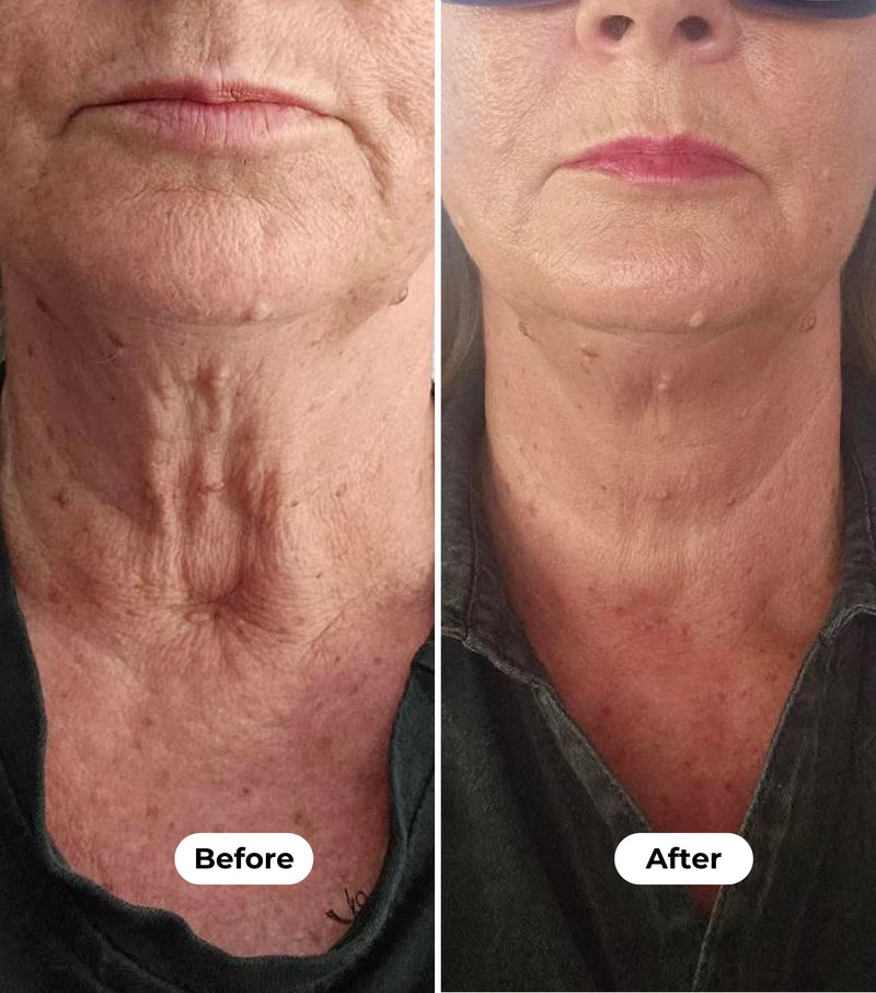 A side-by-side before and after comparison of a woman's neck area, showing sagging skin and stretch marks on the left ('Before') and tighter, smoother skin on the right ('After').