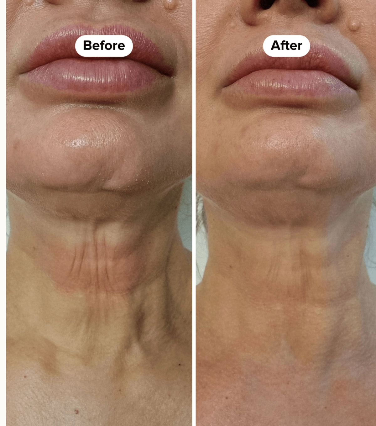 A side-by-side before and after comparison of a woman's neck and lower face, showing skin tightening and reduction in neck wrinkles. The left panel is labeled 'Before' and the right panel 'After'.
