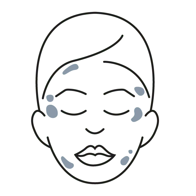 Outline of a face with dots showing dark spots