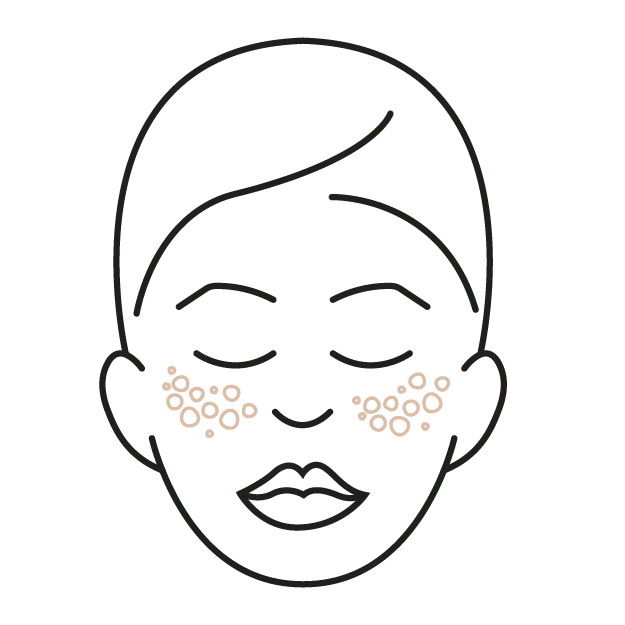 Outline of a face with beige dots on cheeks showing enlarged pores