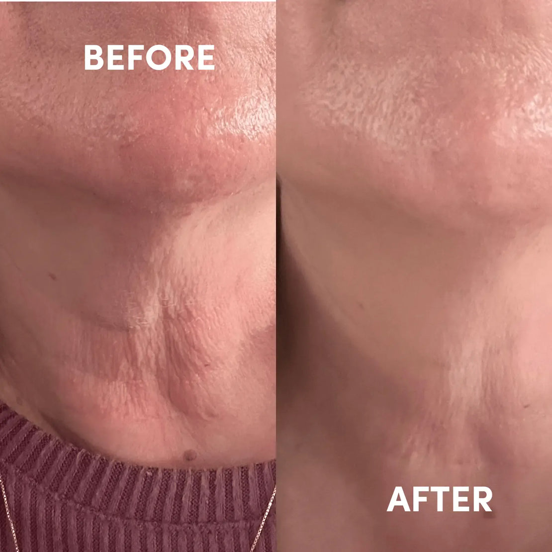 Before and after comparison of women's neck skin texture after using Boost Lab products.